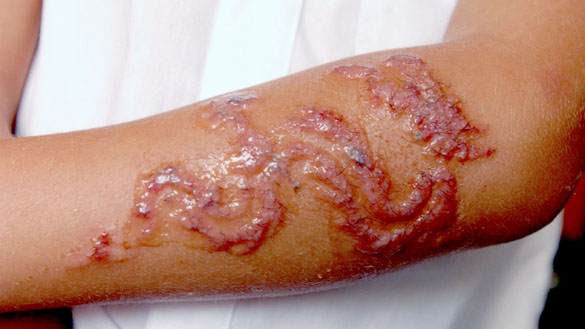 News Team International, 16/9/2003. James Wilson (6) whose arms have blistered badley  after having Henna tattoos done whilst on holiday in Egypt.