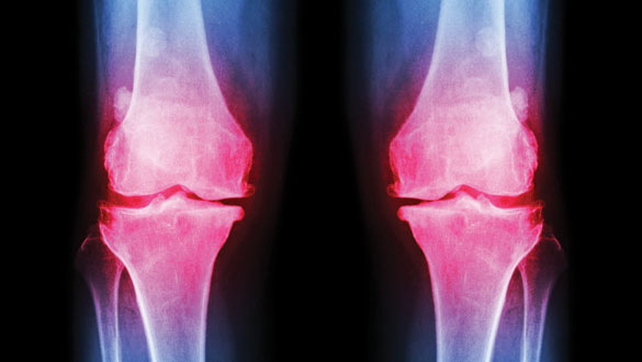 Osteoarthritis_low res