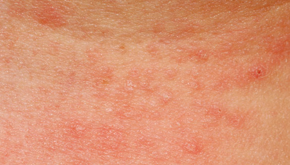 allergic rash dermatitis skin texture